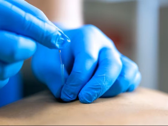 Dry-needling bij Fysiotherapie Dobbe in Almere Poort