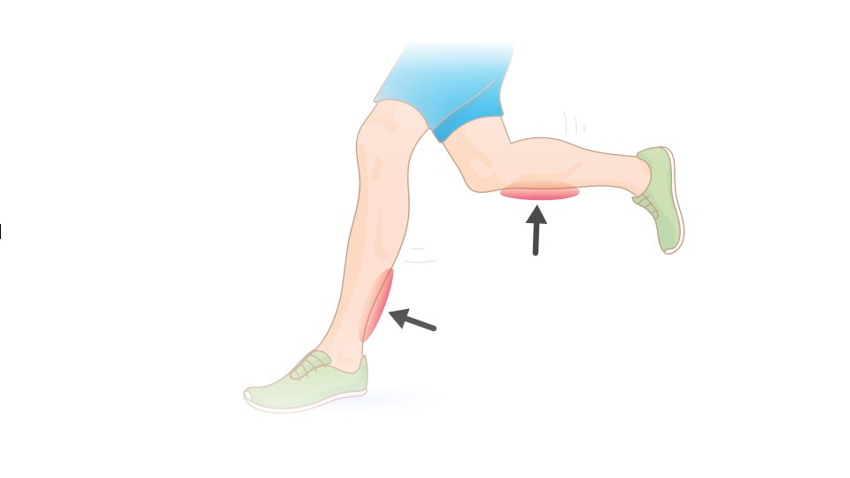 Shin splints: illustratie van een hardloper met pijnlijke plekken aan het onderbeen