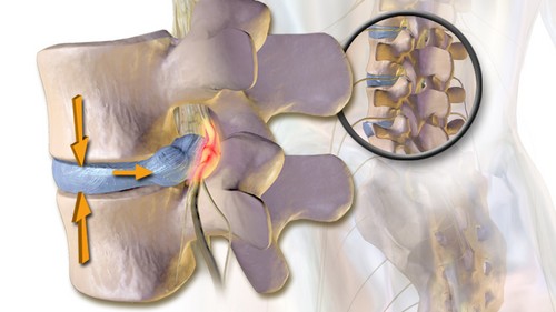 Schematische weergave van een hernia in de lage rug: een uitpuilende tussenwervelschijf die op een zenuwwortel drukt