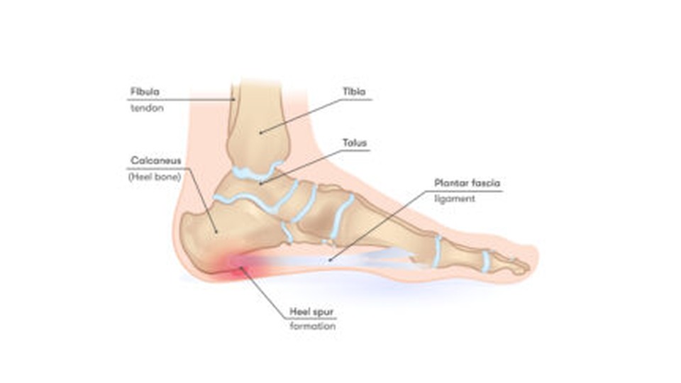 Plantaire fasciitis: illustratie van de voet met pijn onder de hiel