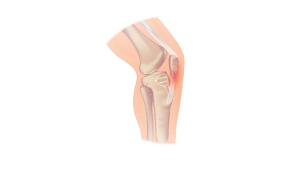 Jumpersknee: illustratie van de knie met pijnlijk gebied bij de patellapees